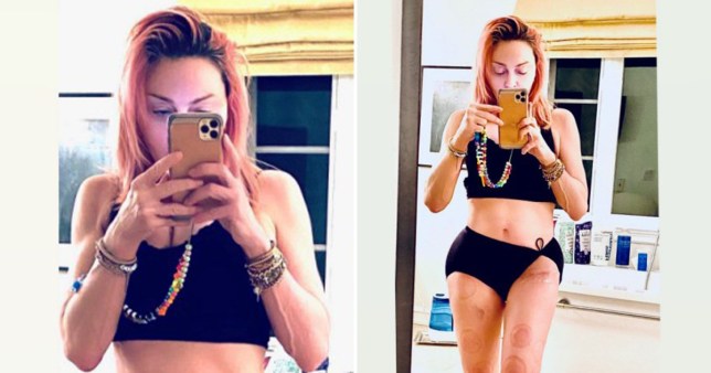 A closer look at Madonna’s hip surgery