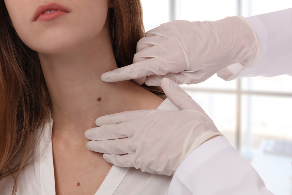 Skin tag removal