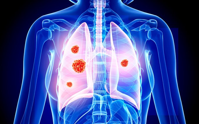 What Causes Lung Cancer? Insights from a Respiratory Consultant