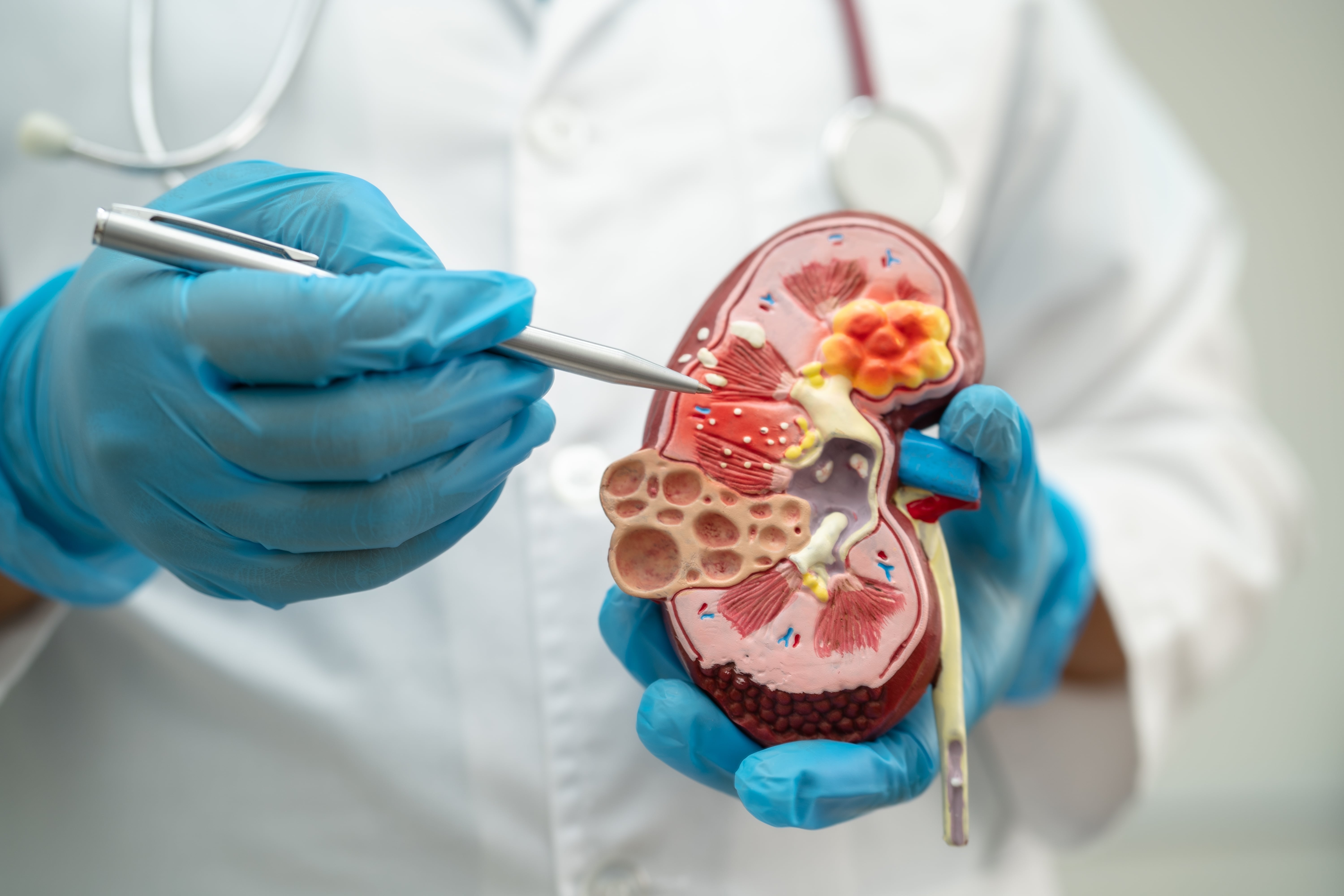 Chronic Kidney Disease - OneWelbeck