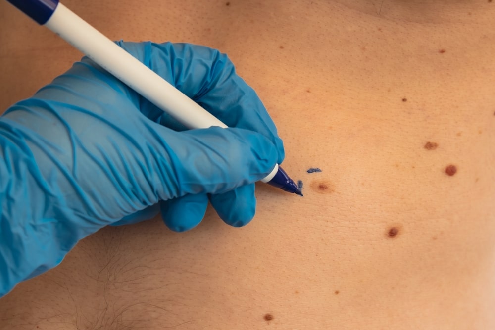 Skin tag aftercare