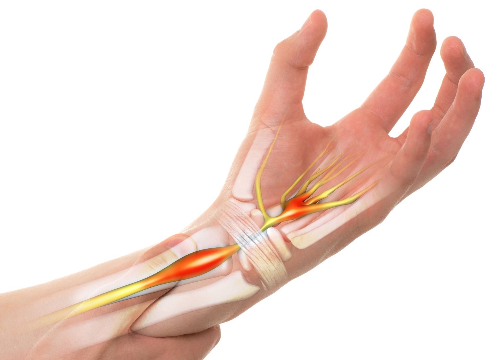 Do I have Carpal Tunnel Syndrome?