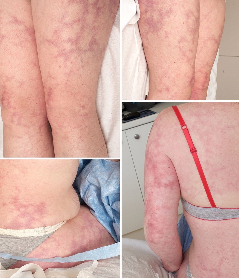Livedo reticularis