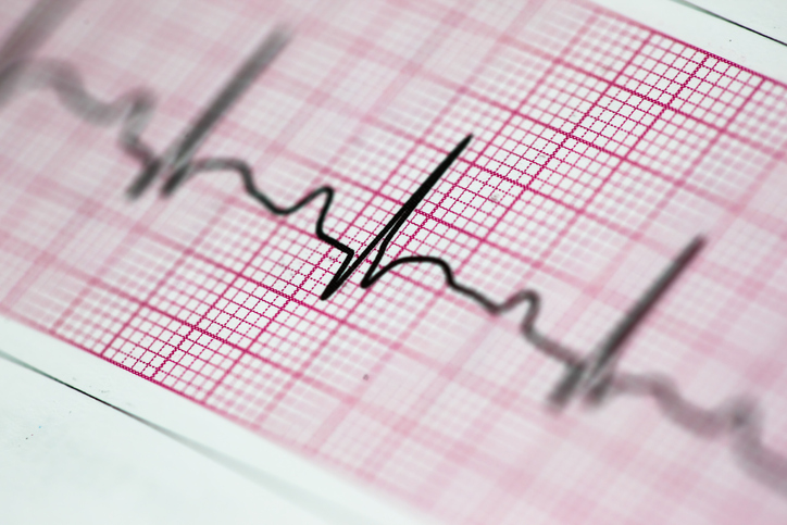 Ablation vs Medication for Atrial Fibrillation