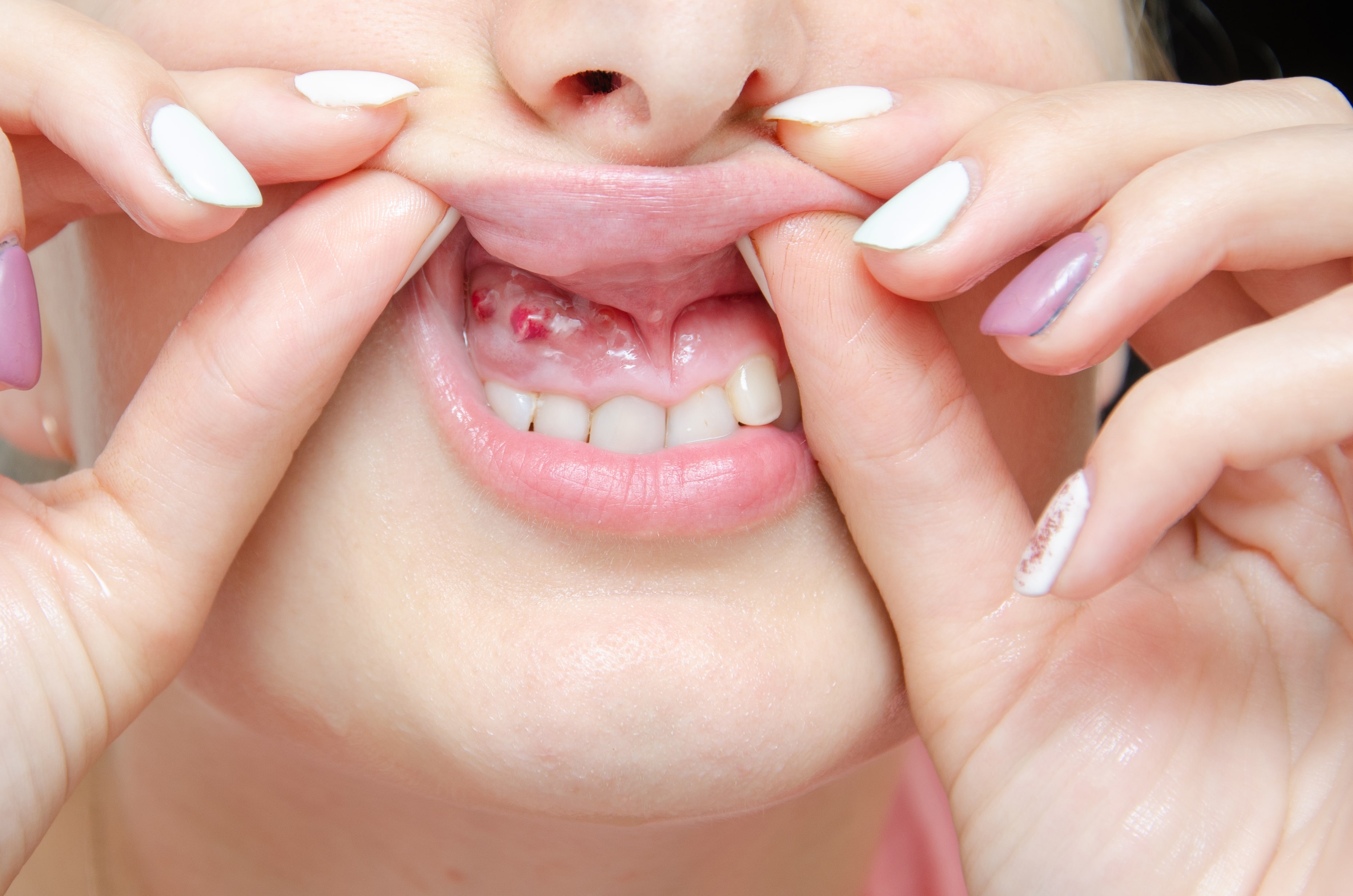 Oral Cysts - OneWelbeck