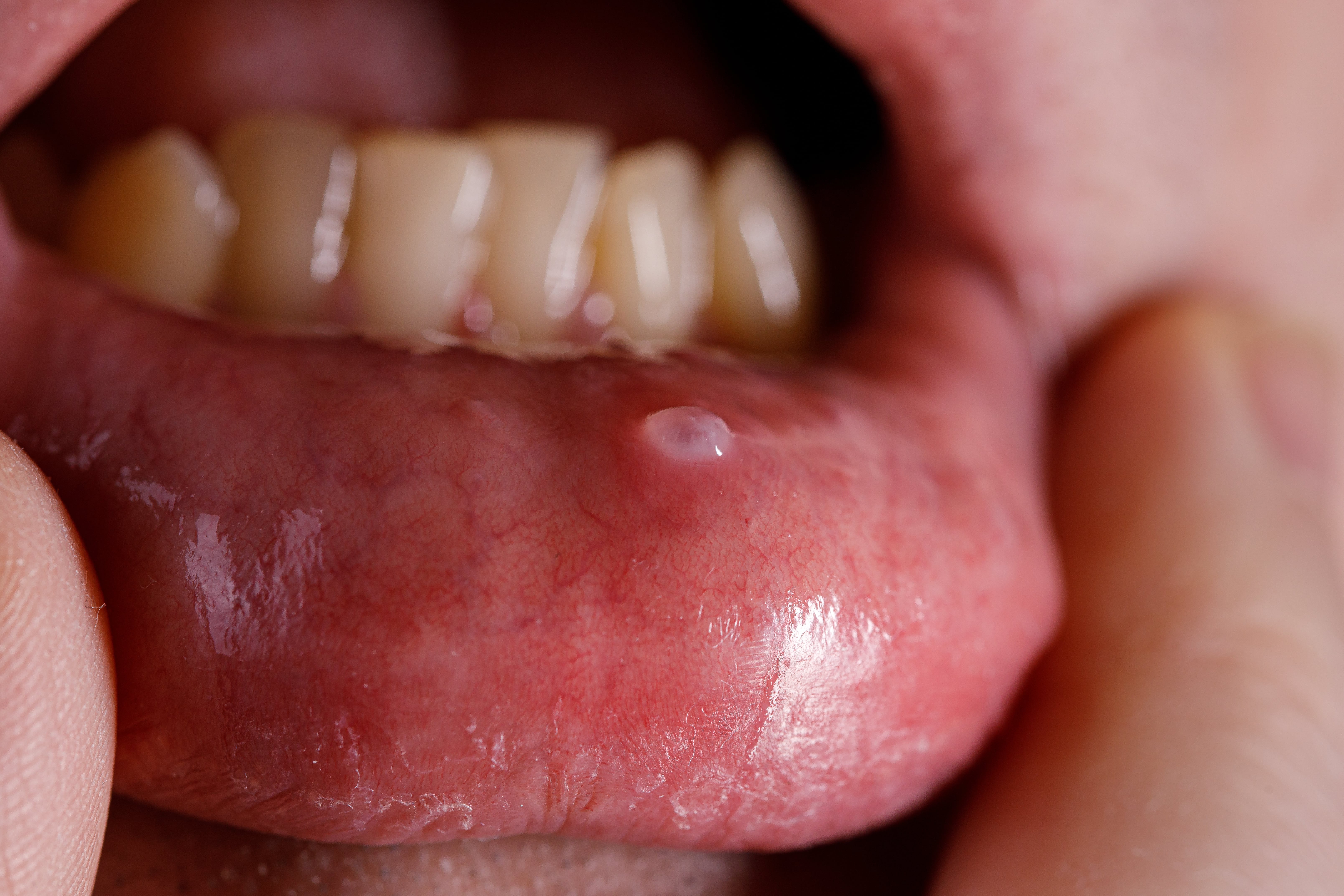 Oral Cysts - OneWelbeck