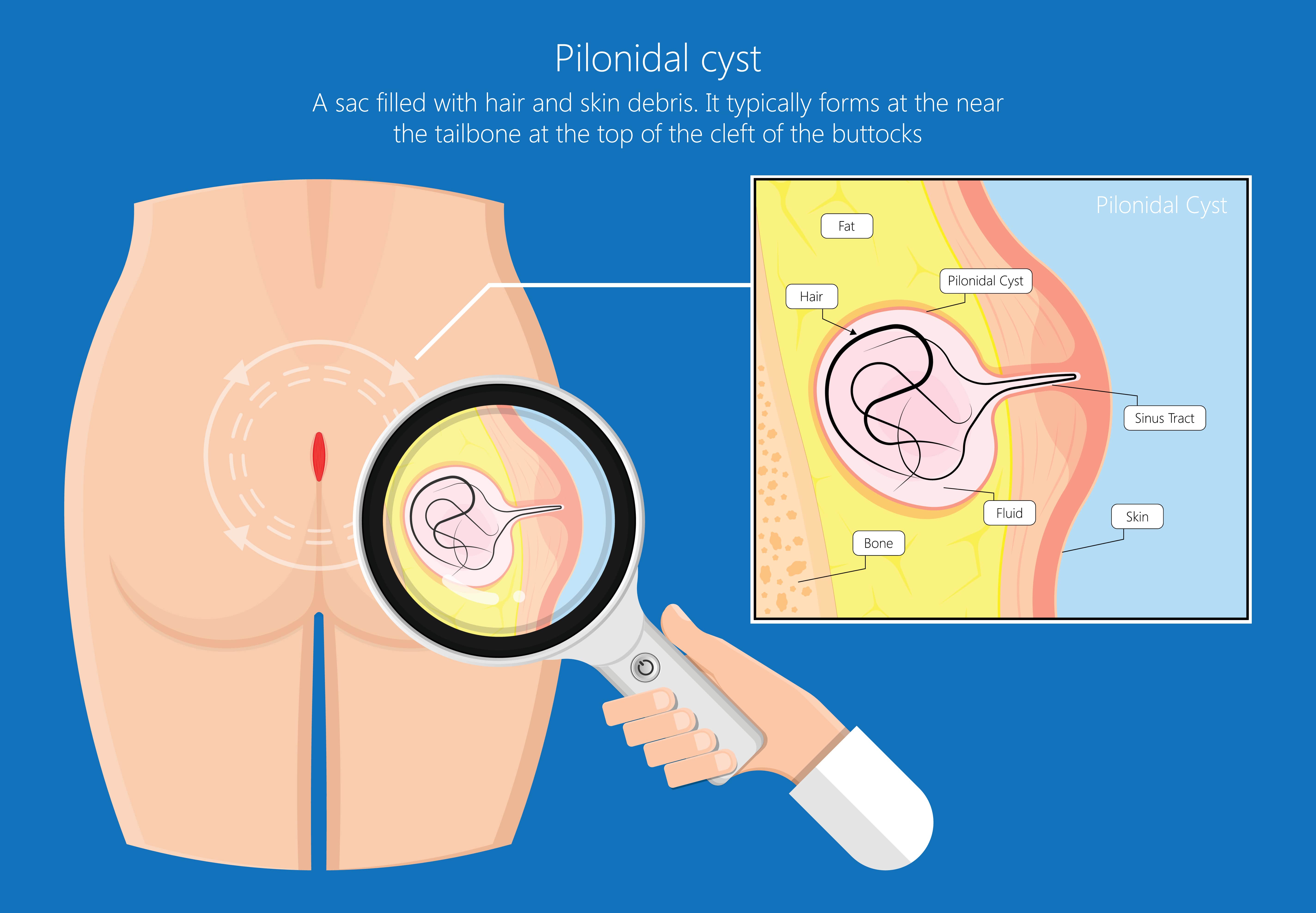 Pilonidal sinus Treatment - OneWelbeck