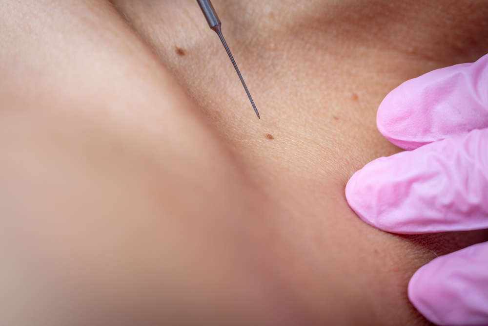 Skin tag removal recovery