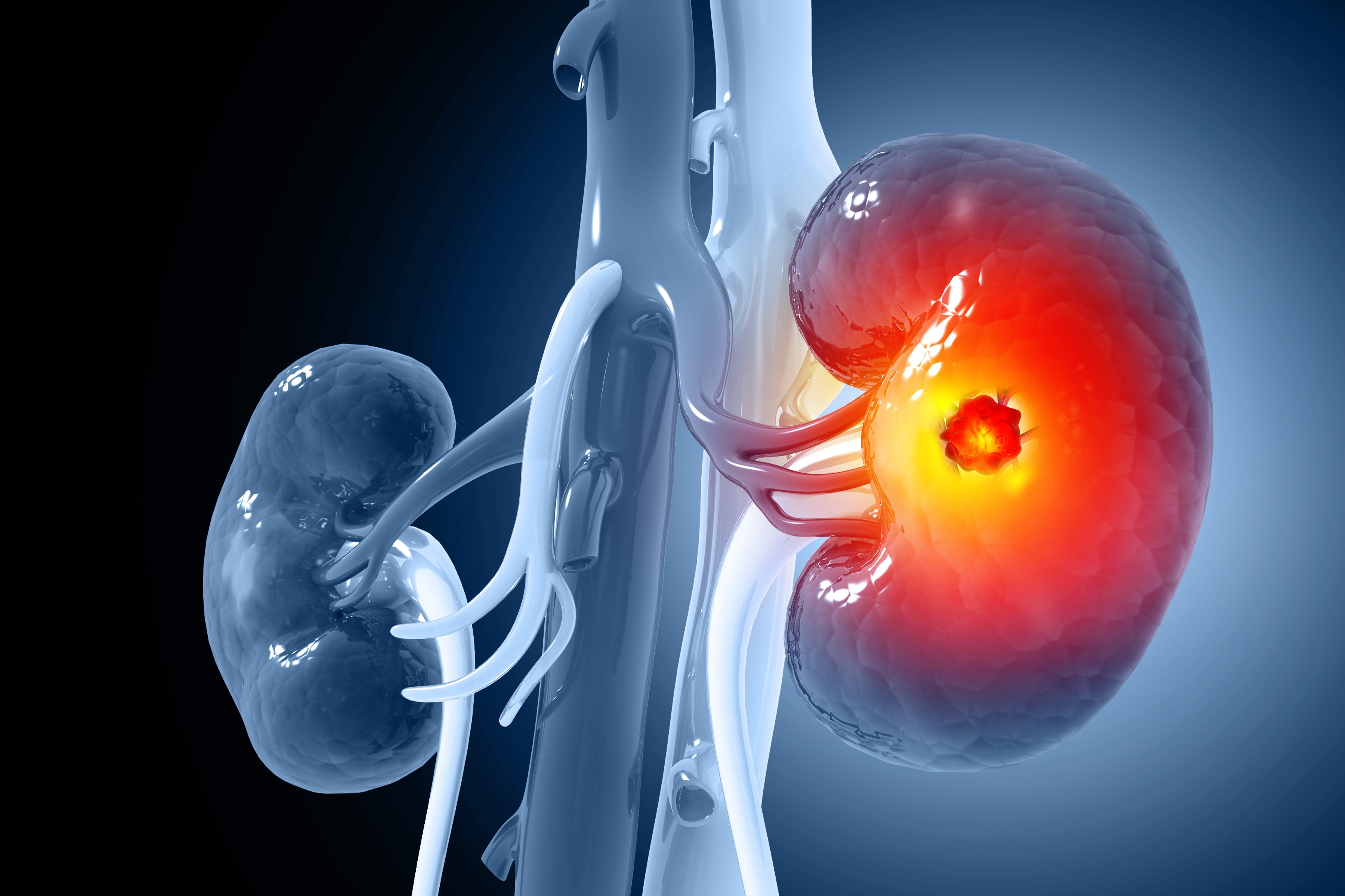 Chronic Kidney Disease - OneWelbeck