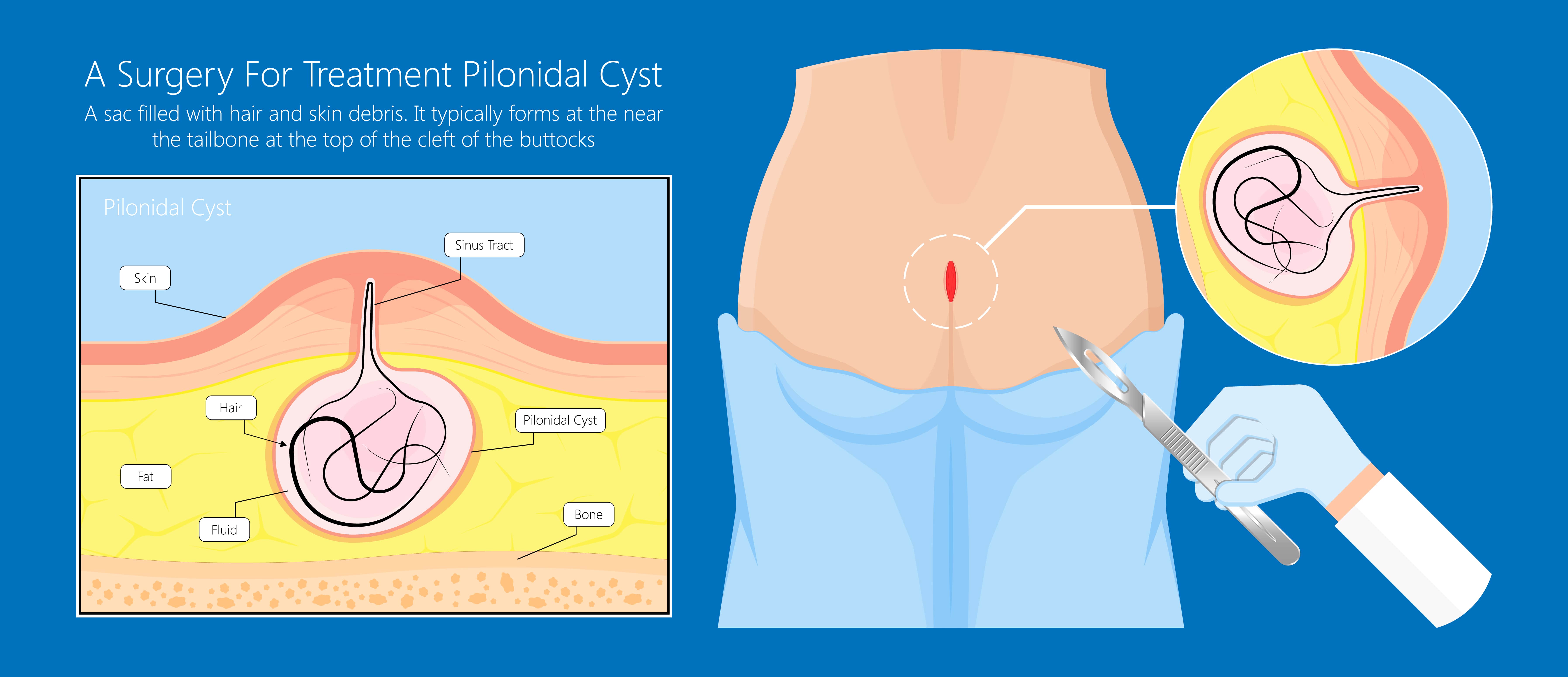Pilonidal Sinus Surgery - OneWelbeck
