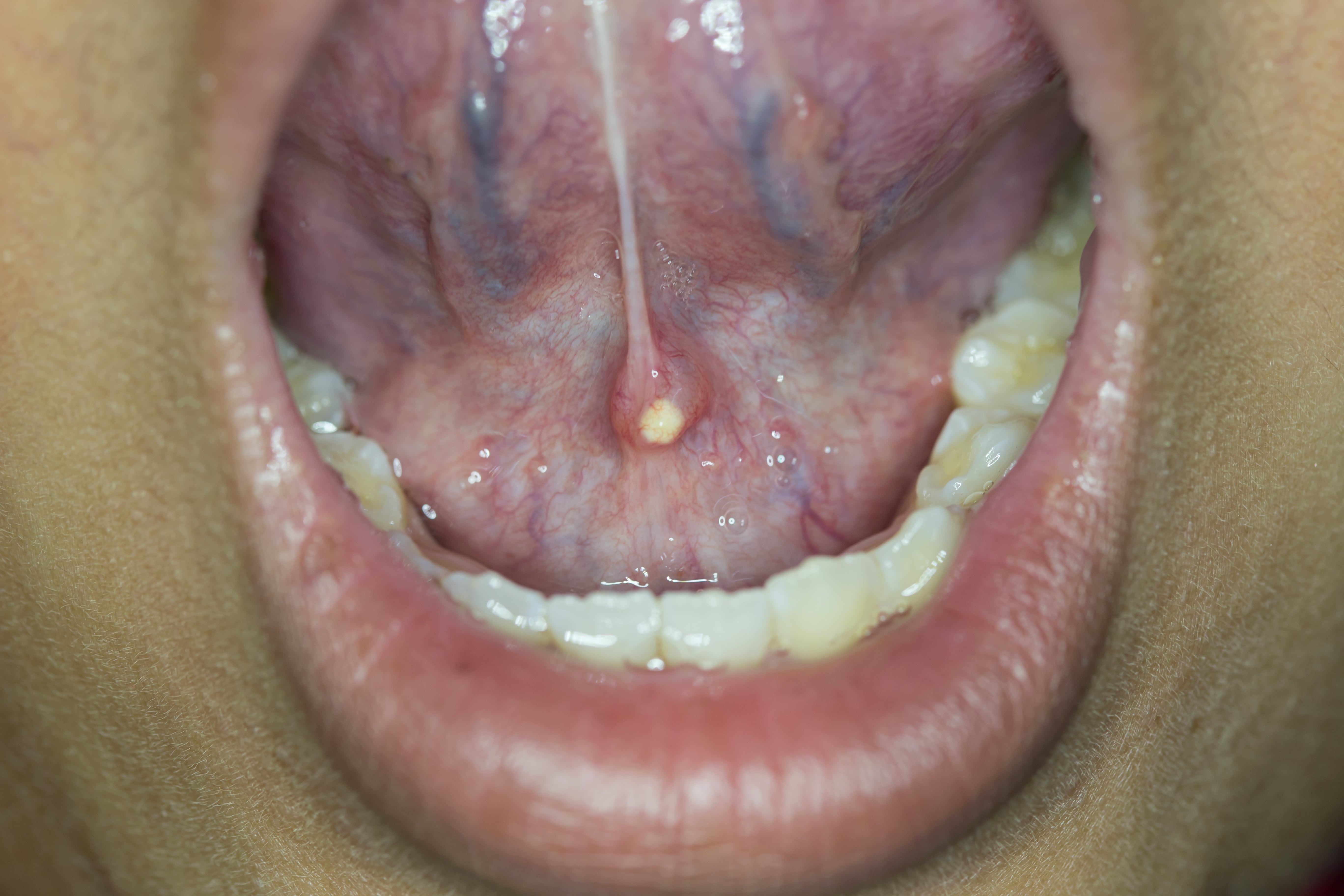 Salivary Gland Stone Treatment - OneWelbeck