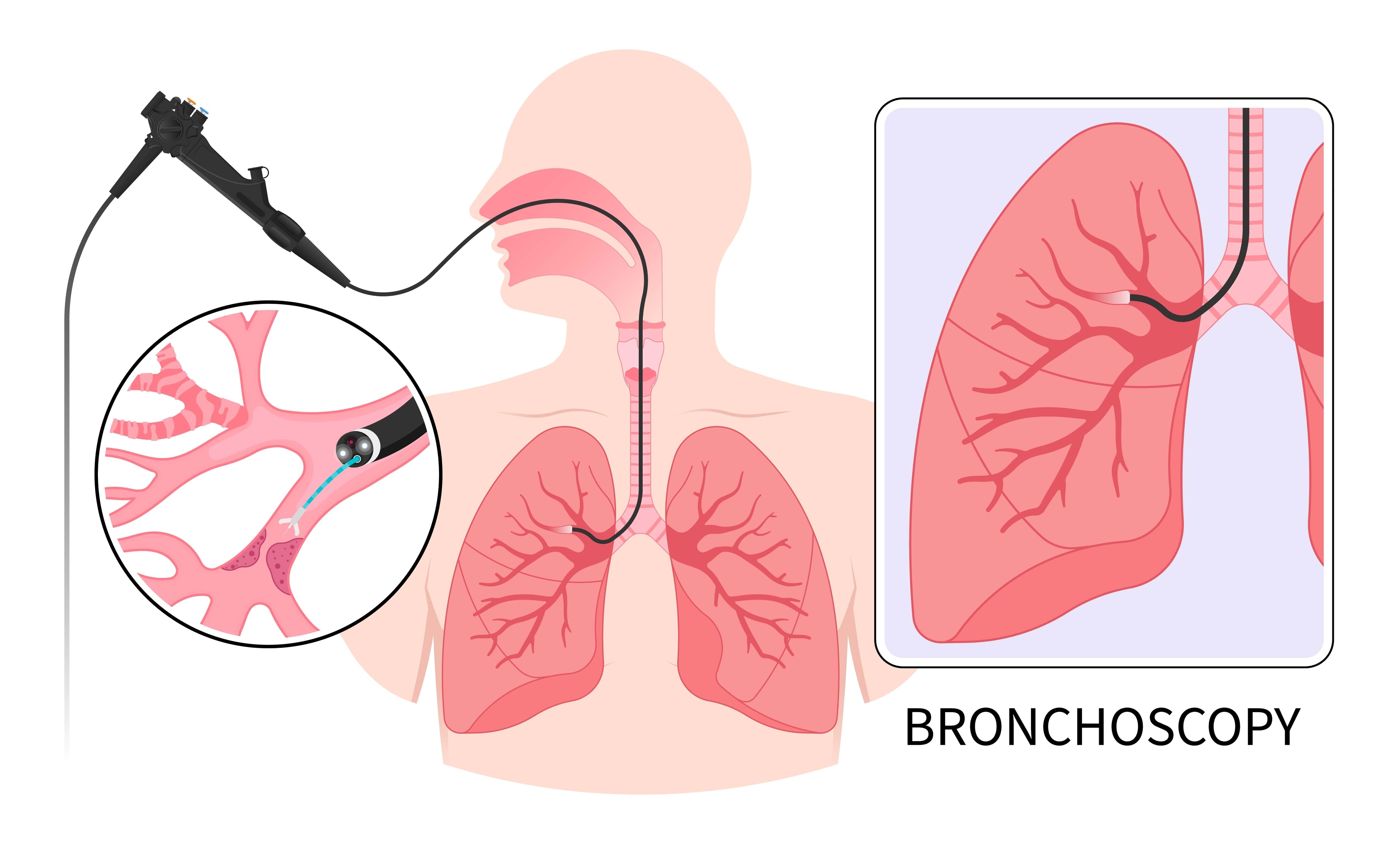 Endobronchial Ultrasound (EBUS) - OneWelbeck