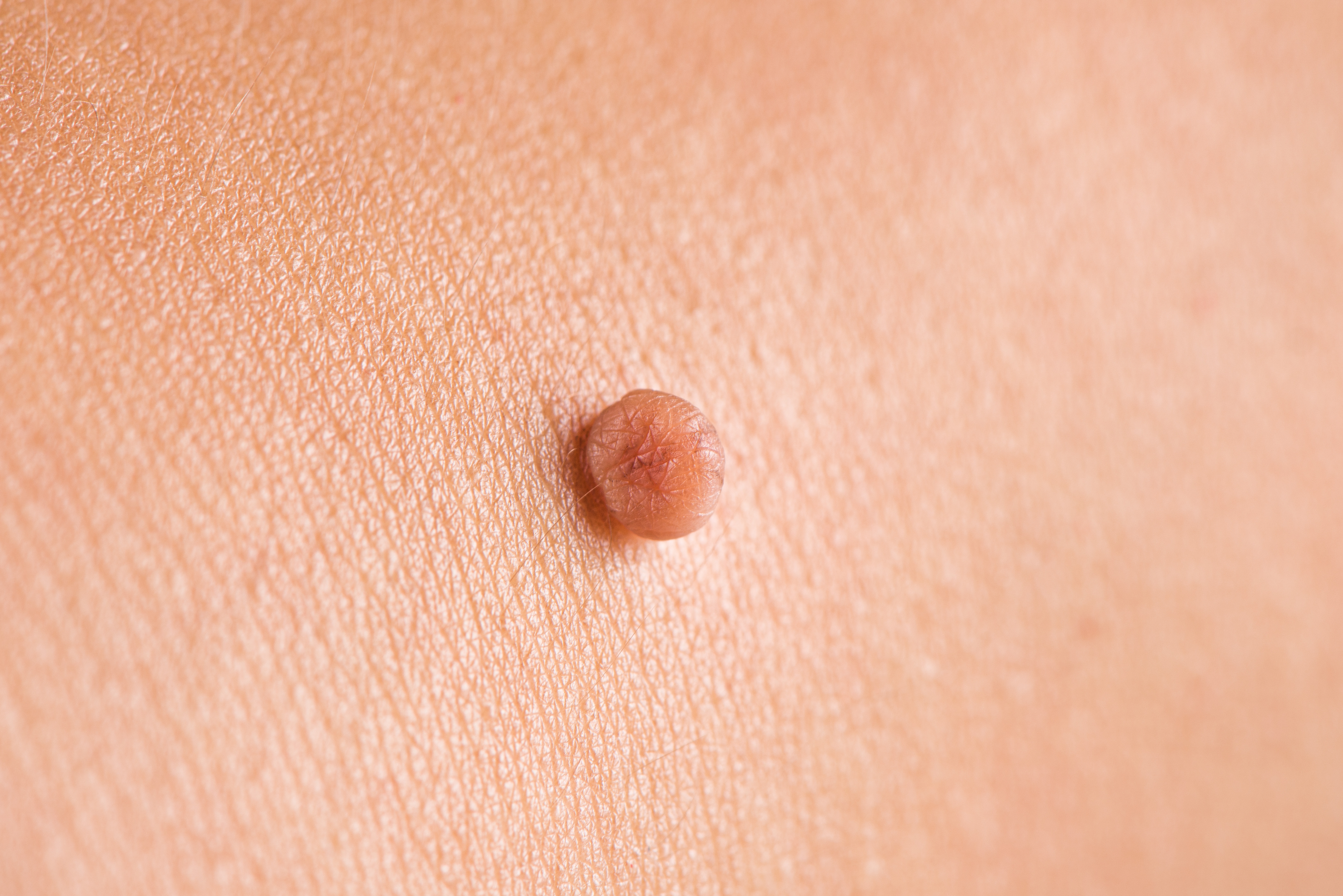 Skin Tags
