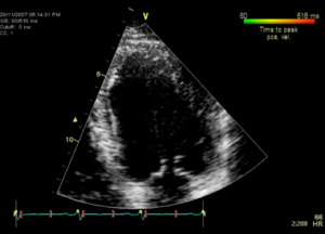 echocardiogram